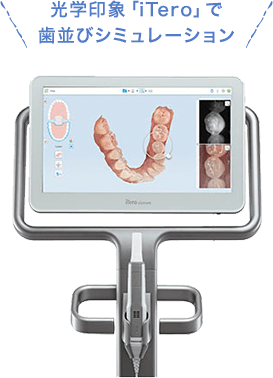 光学印象「iTero」で歯並びシミュレーション