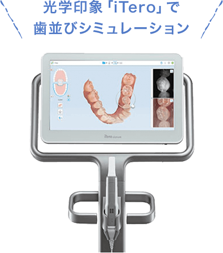 光学印象「iTero」で歯並びシミュレーション