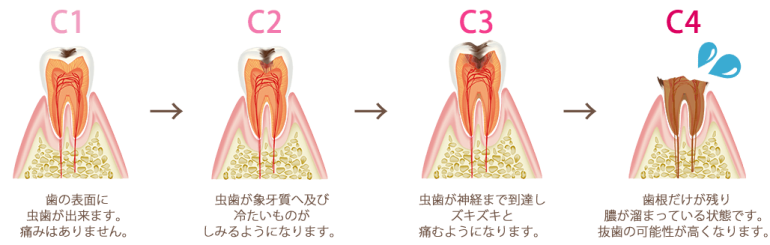 むし歯の原因・進行について